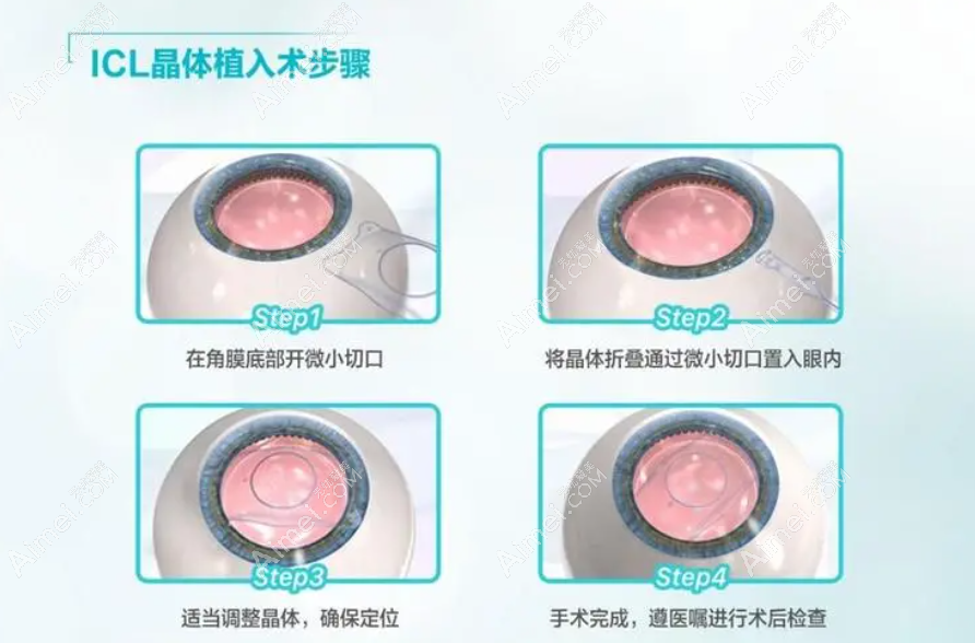 icl晶体植入手术近视眼手术过程和步骤图解
