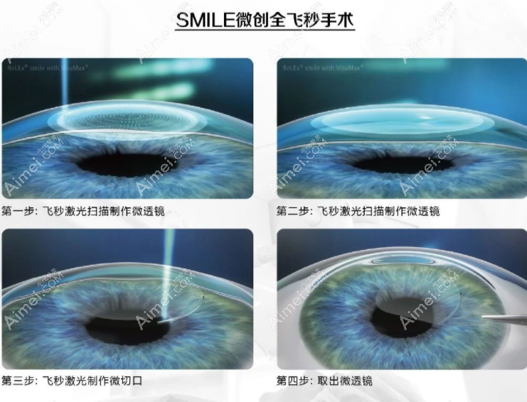 医生做全飞秒激光近视手术后恢复的快