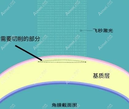 聊城华厦眼科飞秒手术技术图