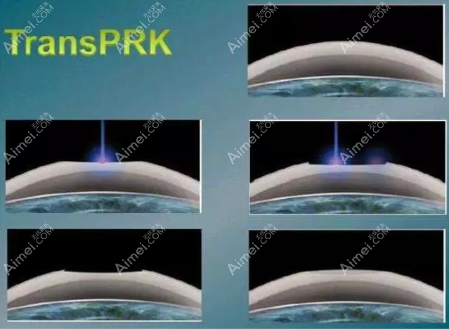 Transprk全激光角膜表层手术过程图解