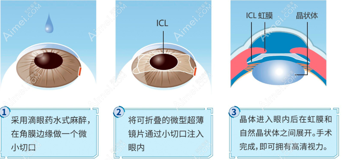 icl人工晶体植入手术利与弊:可矫正1800度近视,但价格贵25000起