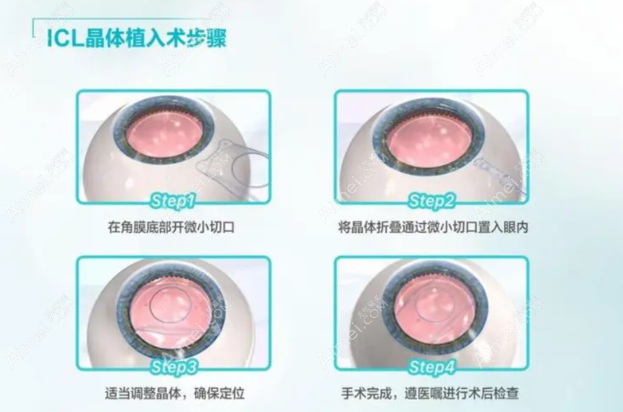 高度近视icl人工晶体植入过程和步骤