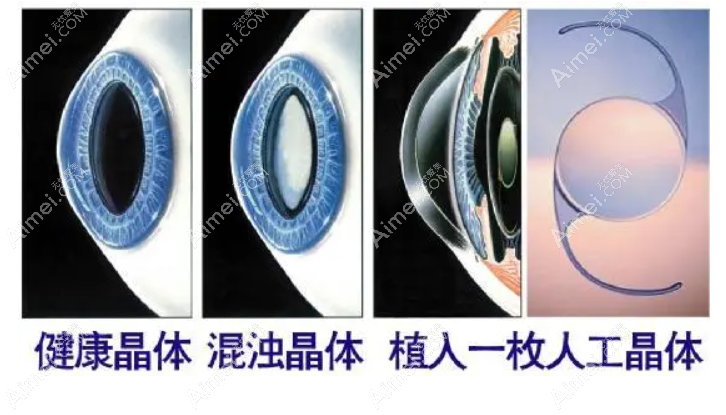 三焦点人工晶体亲身经历和感受