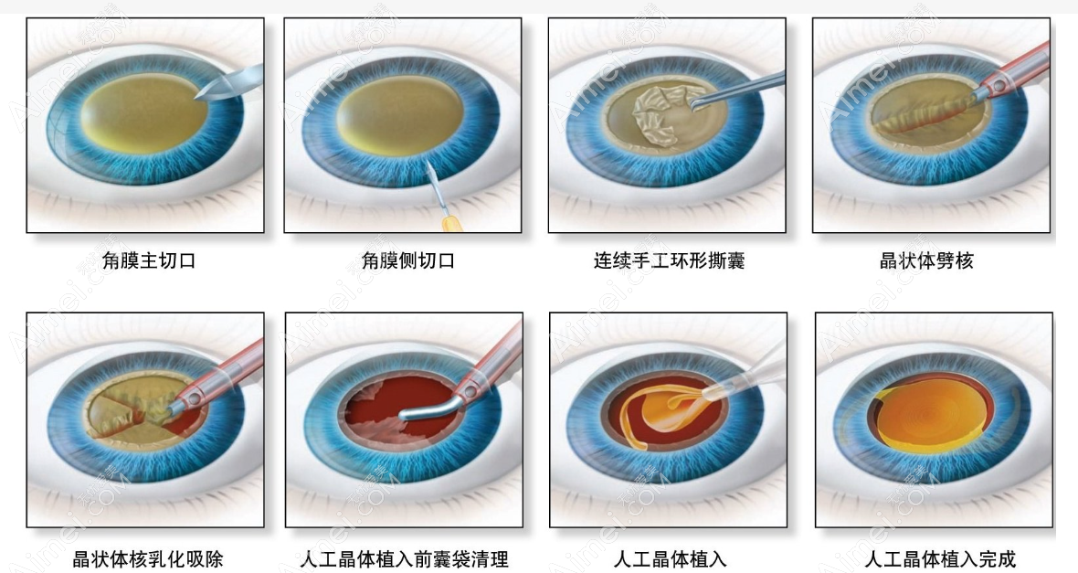深圳白內(nèi)障手術(shù)報(bào)銷申請(qǐng)條件