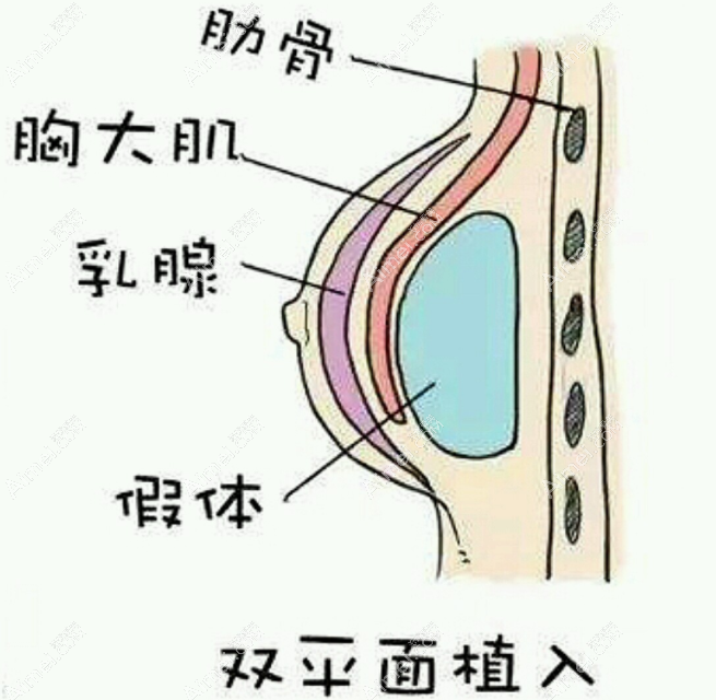 刘杰伟做假体隆胸术后胸型好看