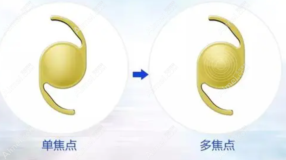 深圳白内障手术人工晶体价格和住院总费用 深圳白内障手术人工晶体价格和住院总费用