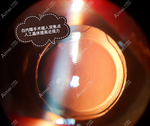 深圳散光型单焦点人工晶体价格aimei.com 深圳散光型单焦点人工晶体价格aimei.com