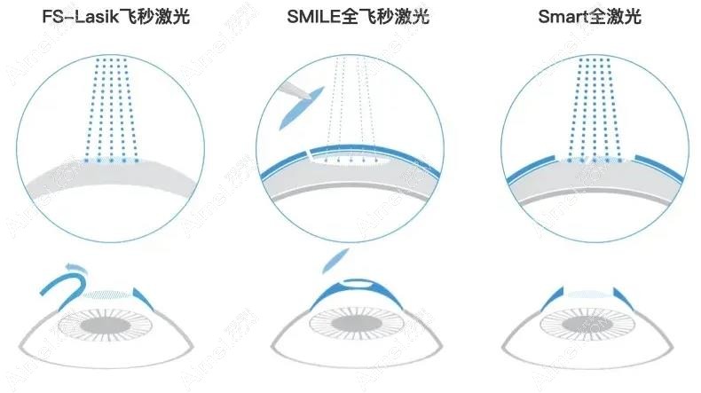 长春近视激光手术不同方式