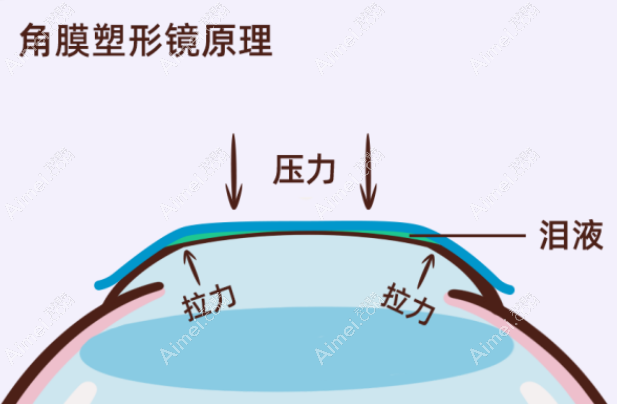 珠海儿童角膜塑形镜矫正近视价格5000-11000元起