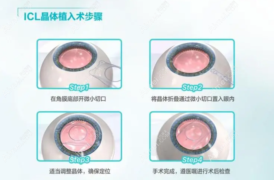 icl晶体植入手术过程和步骤