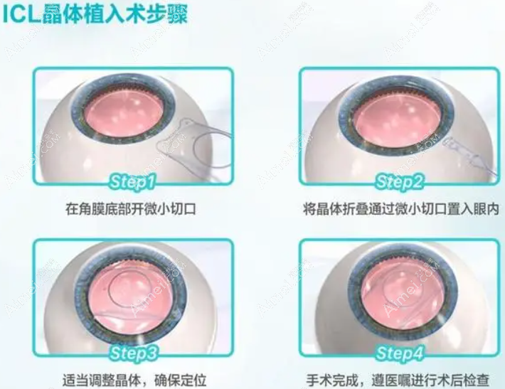 北京爱尔眼科icl晶体植入近视手术费用