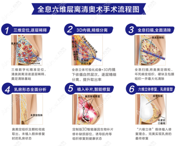 广州荔湾医院取奥美定取出技术好