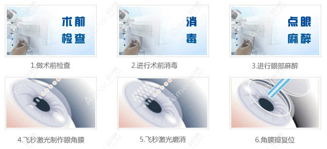 温州激光近视手术费用多少钱