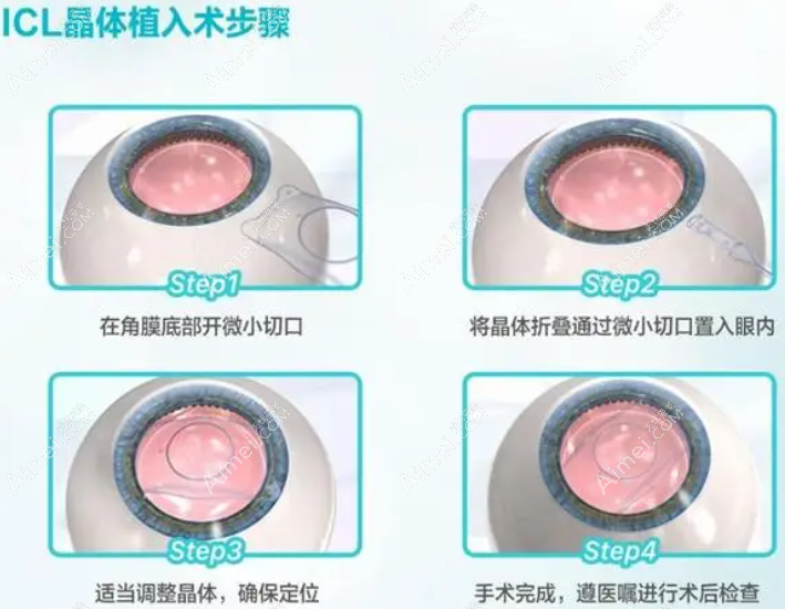 温州icl晶体植入手术多少钱