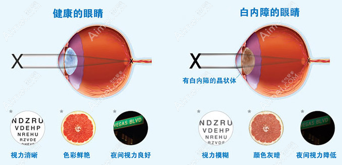 北京白内障超声乳化晶体摘除手术价格