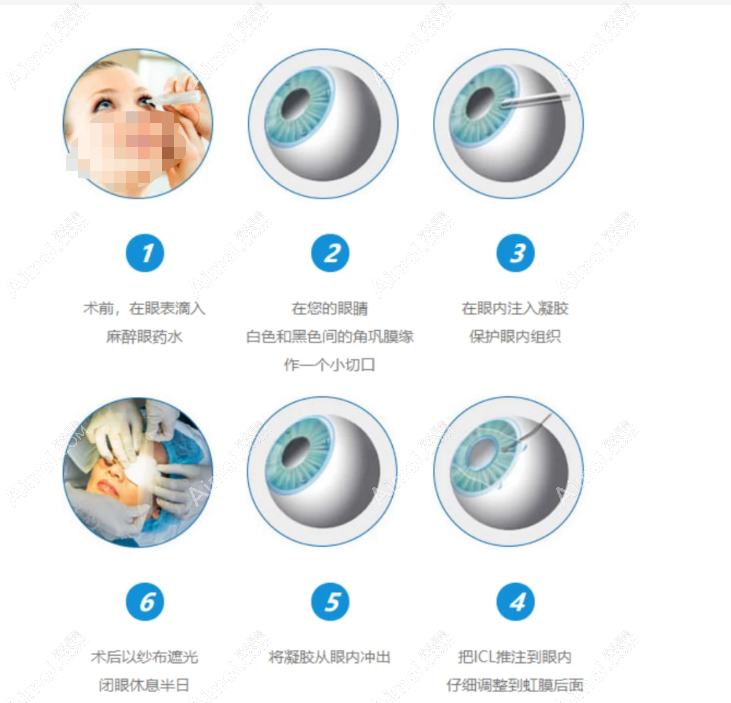 ICL晶体植入近视眼手术过程和步骤