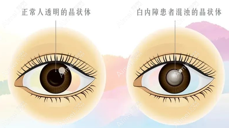 北京白内障人工晶体植入手术多少钱