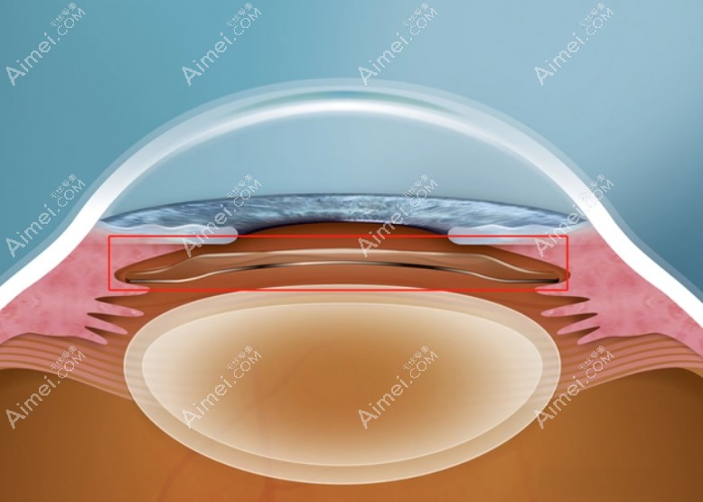 icl的五大危害和弊端揭秘:ICL晶体植入近视眼手术前必看攻略