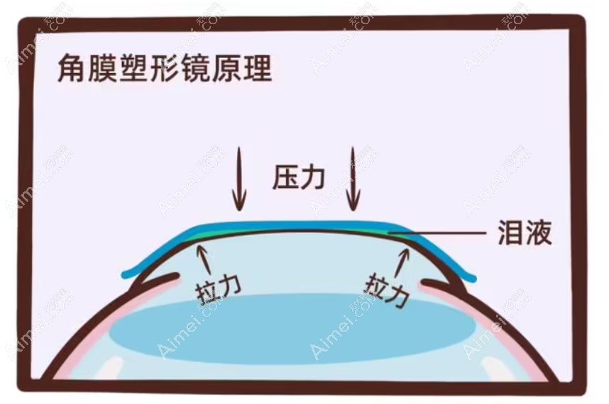 深圳阿尔法角膜塑形镜优势及原理