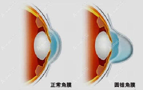 圆锥角膜是什么原因形成的