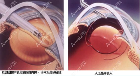 福州白内障超声乳化+人工晶体植入手术 福州白内障超声乳化+人工晶体植入手术