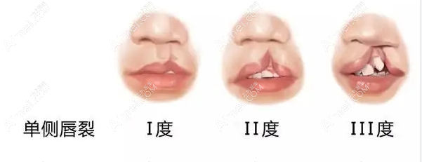 广州广大医院可以修复唇裂类型