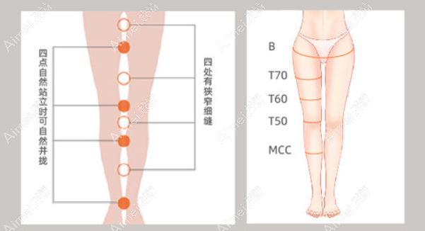 北京禾美嘉整形做腿型矫正手术好吗