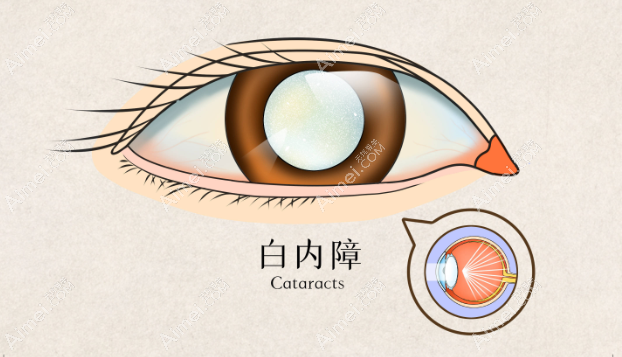为什么白内障手术一次只做一只眼