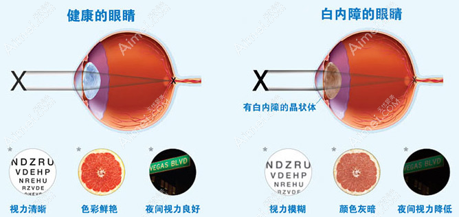 千万别做单眼白内障手术