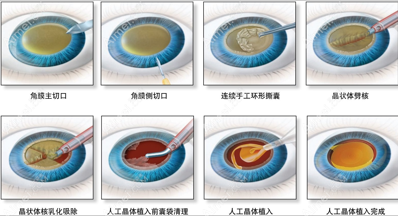 白内障超声和飞秒激光哪个好?飞秒激光更好创伤小恢复得快