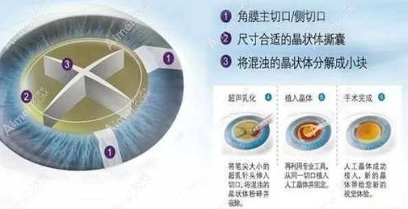 白内障飞秒激光晶体植入手术过程
