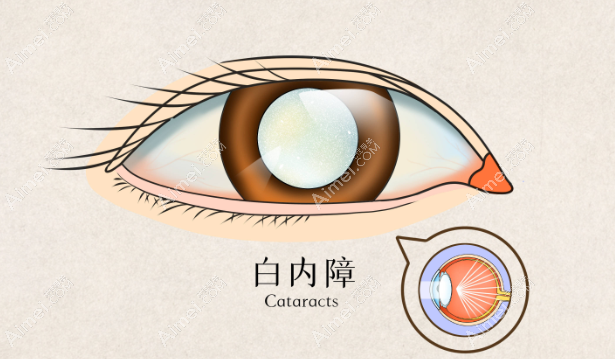 温州白内障单焦晶体植入手术多少钱