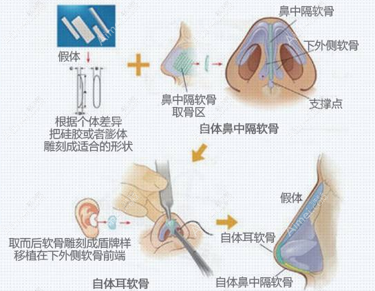 国内隆鼻有名的医生技术好 国内隆鼻有名的医生技术好