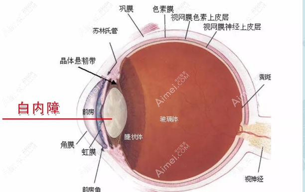 70岁老人白内障手术选择哪种人工晶体好