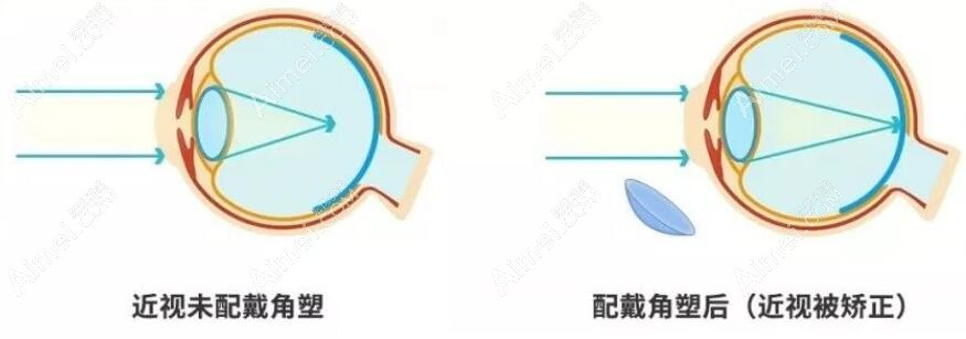 常州配角膜塑形镜选正规眼科疗效好