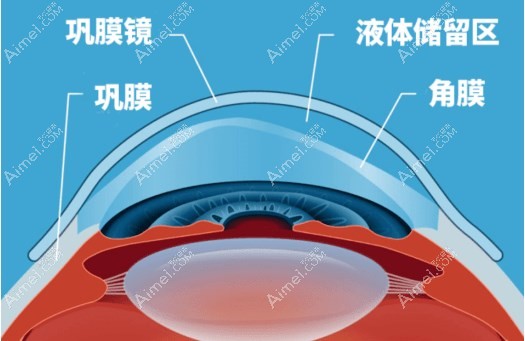 巩膜镜的作用是什么?可矫正圆锥角膜/中高度干眼/角膜损伤