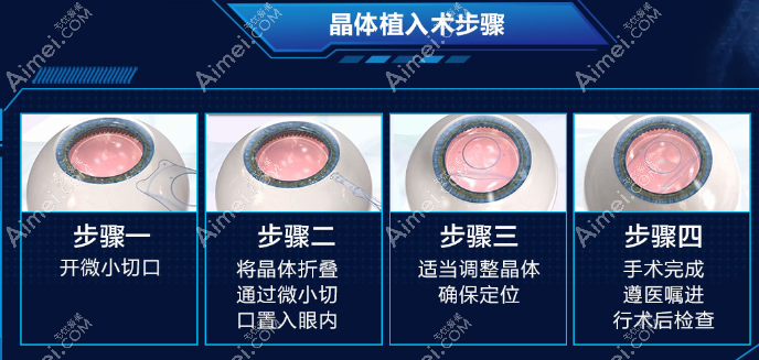 icl晶体植入近视手术伤害更大吗 icl晶体植入近视手术伤害更大吗