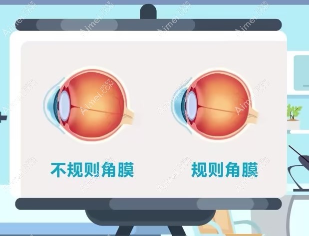 巩膜镜的作用是什么