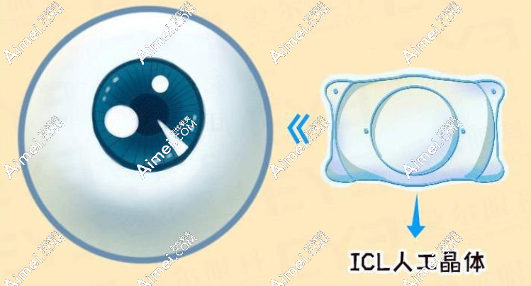 福州icl晶体植入近视眼手术哪个医院好?亮睛-黑马眼科技术好