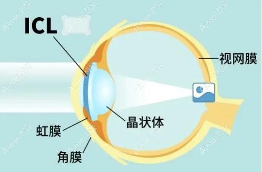 武汉icl晶体植入手术好的医院排名前三推荐