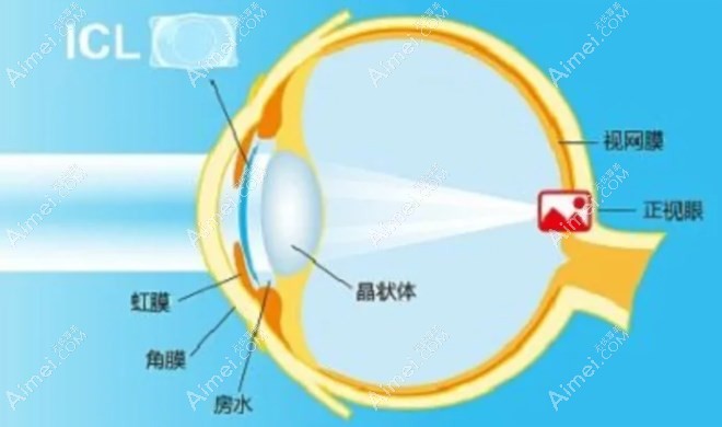 icl手术后永远不能揉眼吗爱美网