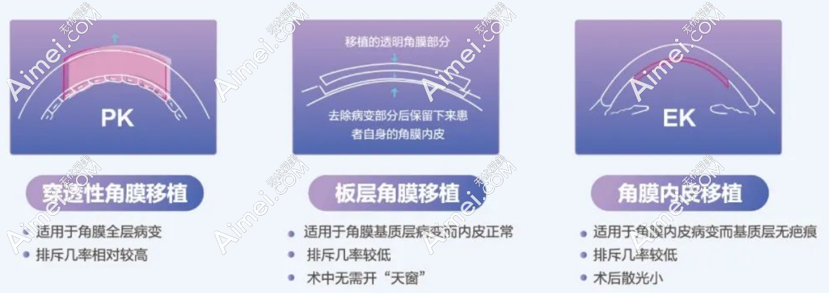 角膜移植手术3种方法恢复时间不同
