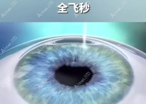 全飞秒第二天视力达到0.8算正常吗?视力0.8还能恢复到1.0吗?