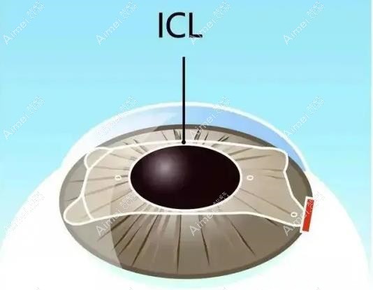 乌鲁木齐美尼康眼科icl晶体植入手术