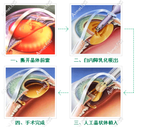 广州白内障晶体植入过程