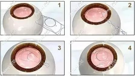 近视眼植入人工晶体手术过程www.aimei.com