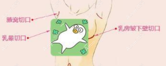 出彩医美十分钟隆胸手术创伤小恢复的快 出彩医美十分钟隆胸手术创伤小恢复的快
