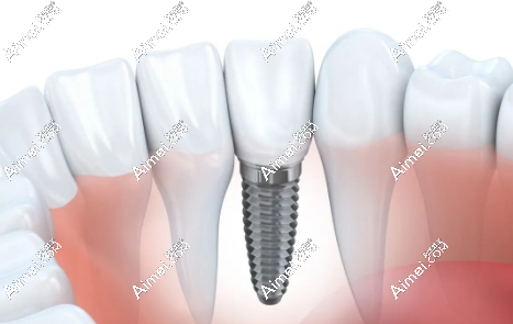 杭州雅莱口腔医院种植牙价格 杭州雅莱口腔医院种植牙价格