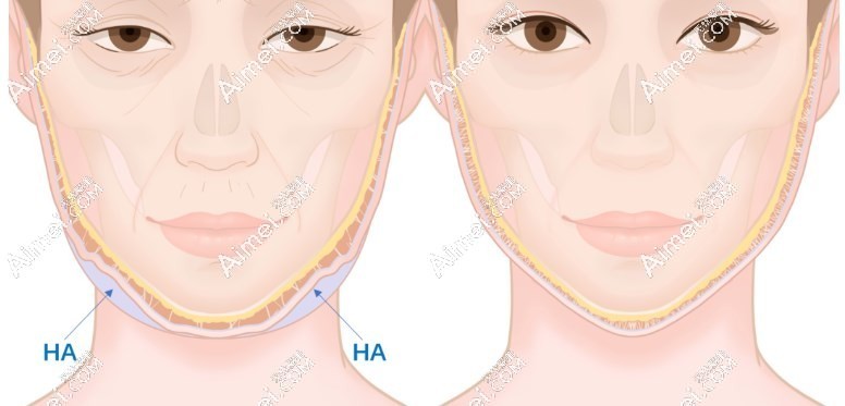 打面部馒化修复收紧针消除馒化脸对比图片爱美网