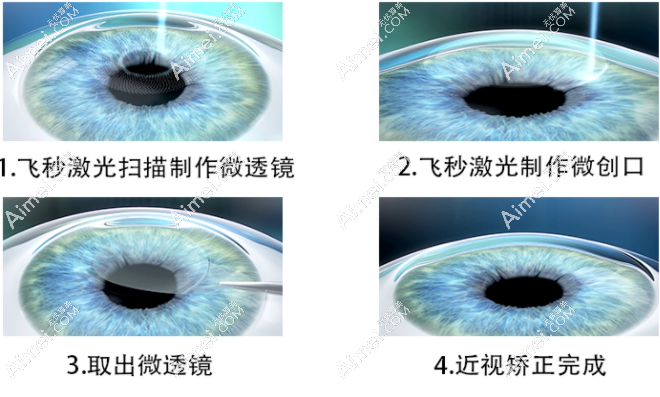 广州常春藤眼科做全飞秒近视眼技术好